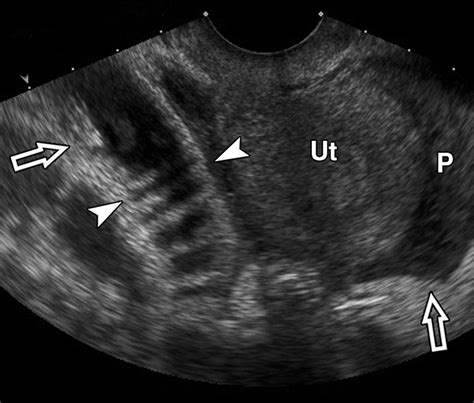 Ultrasound Imaging of Bowel Pathology: Technique 